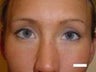 Asian eyelid surgery