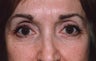 Eyelid Surgery