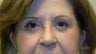 Eyelid Surgery
