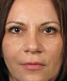 Eyelid Surgery