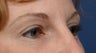 Eyelid Surgery