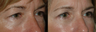Eyelid Surgery