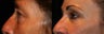 Eyelid Surgery