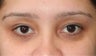 Eyelid Surgery