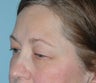 Eyelid Surgery