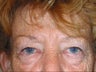 Eyelid Surgery