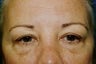 Eyelid Surgery