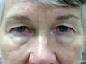Eyelid Surgery