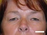 Eyelid Surgery