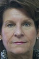 Eyelid Surgery