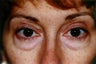 Eyelid Surgery