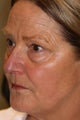 Eyelid Surgery