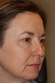 Eyelid Surgery