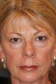 Eyelid Surgery