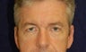 Eyelid Surgery