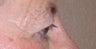 Eyelid Surgery