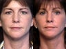Eyelid Surgery