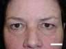 Eyelid Surgery