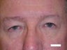 Eyelid Surgery