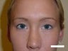 Asian eyelid surgery