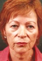 Eyelid Surgery
