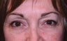 Eyelid Surgery