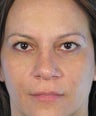 Eyelid Surgery
