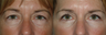 Eyelid Surgery