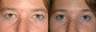 Eyelid Surgery