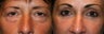 Eyelid Surgery
