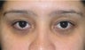 Eyelid Surgery