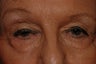 Eyelid Surgery