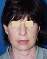 Facelift