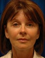 Facelift