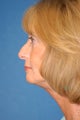 Facelift