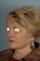 Facelift