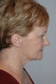 Facelift