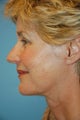 Facelift