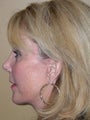 Facelift