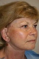Facelift