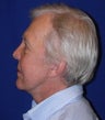 Facelift