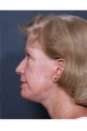 Facelift