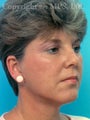 Facelift