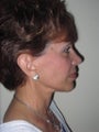 Facelift