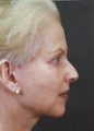 Facelift