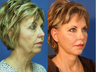 Facelift