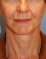 Facelift