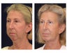 Facelift