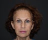 Facelift