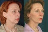Facelift